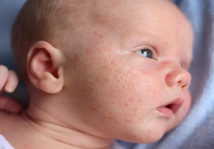 علاج حبوب الصيف عند الاطفال بكل بساطه 👶