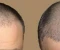 صورة مقال زراعة الشعر وكيف تتم هذه العملية؟