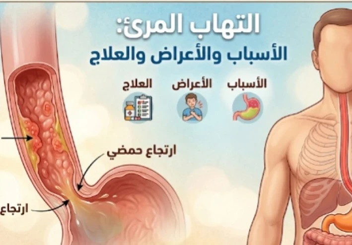 التهاب المريء (Oesophagitis - K20)