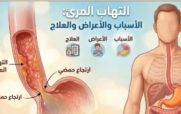 التهاب المريء (Oesophagitis - K20)