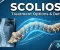 صورة مقال Scoliosis: Understanding Spinal Curvature and Its Impact on Human Health