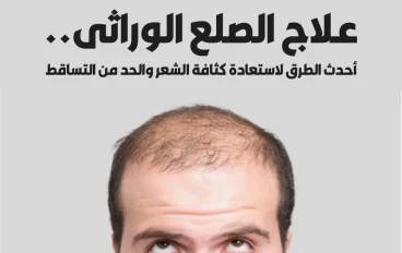 علاج الصلع الوراثي.. أحدث الطرق لاستعادة كثافة الشعر والحد من التساقط