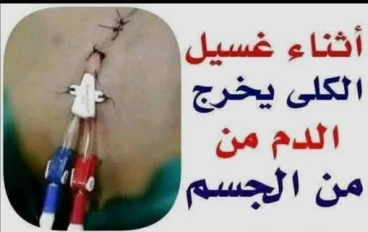 الكلي آية من آيات الله في جسد الإنسان 