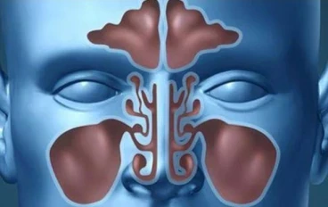 تنفس بحرية.. دليل مبسط لفهم التهاب الجيوب الأنفية وكيفية التغلب عليه بأساليب منزلية وطبية ناجحة