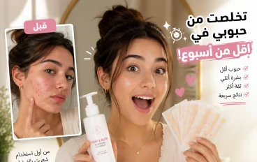 كيفية التخلص من حبوب الشباب في اقل من اسبوع واحد فقط و اهم النصائح لتقليل ظهورها بعد علاجها 