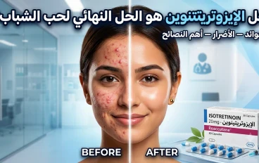 هل الإيزوتريتينوين هو الحل النهائي لحب الشباب؟