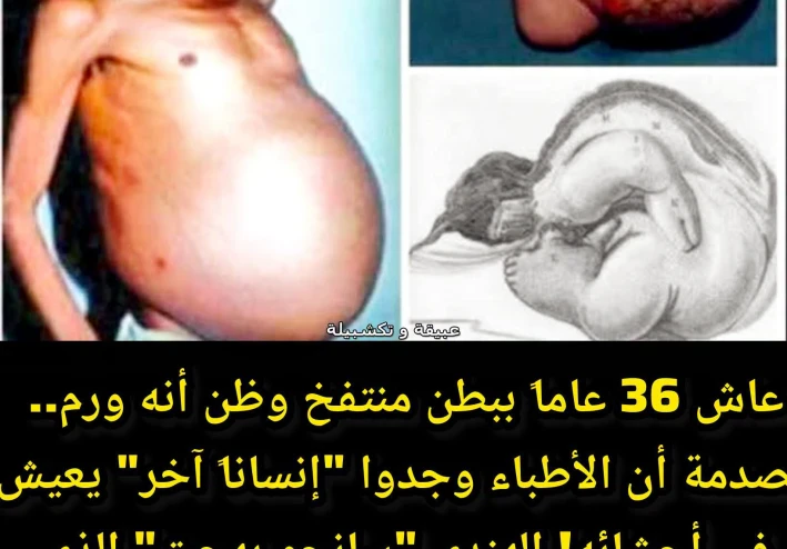 قصة مذهلة لا تُصدق: عاش 36 عامًا يحمل "توأمه" داخل بطنه!  ---