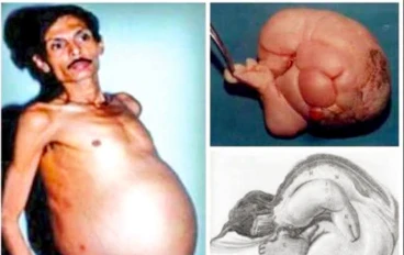 قصة مذهلة لا تُصدق: عاش 36 عامًا يحمل "توأمه" داخل بطنه!  ---