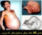 صورة مقال قصة مذهلة لا تُصدق: عاش 36 عامًا يحمل "توأمه" داخل بطنه!  ---