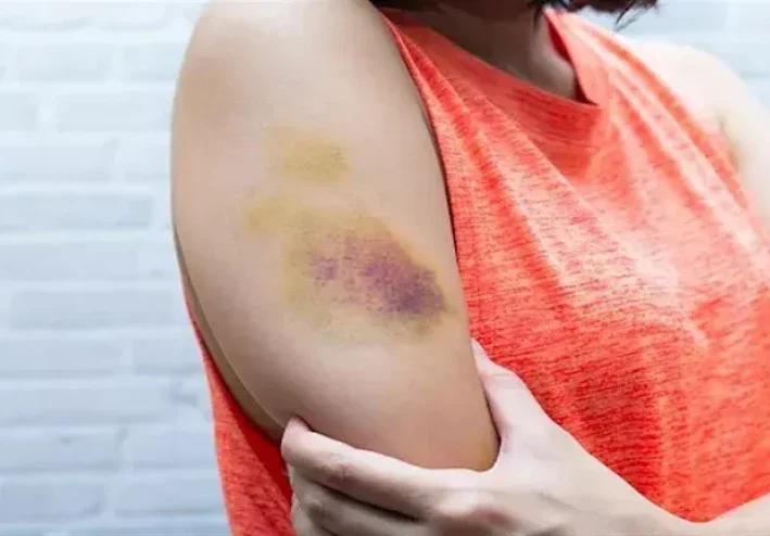 أسباب ظهور كدمات عند الاستيقاظ صباحًا.. متى تكون طبيعية ومتى تستدعي زيارة الطبيب؟