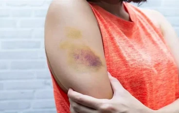 أسباب ظهور كدمات عند الاستيقاظ صباحًا.. متى تكون طبيعية ومتى تستدعي زيارة الطبيب؟