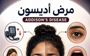 مرض أديسون Addison's Disease 
