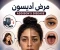 صورة مقال مرض أديسون Addison's Disease 