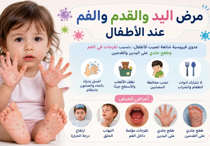 مرض اليد والقدم والفم عند الأطفال: الأعراض والعلاج وطرق الوقاية.