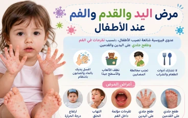 مرض اليد والقدم والفم عند الأطفال: الأعراض والعلاج وطرق الوقاية.