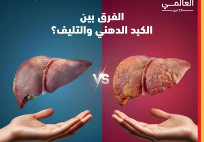 دهون الكبد: العدو الصامت.. كيف تتكون وكيف تستعيد كبدك؟