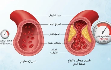 ارتفاع ضغط الدم (Hypertension) - التقييم والإدارة السريرية