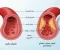 صورة مقال ارتفاع ضغط الدم (Hypertension) - التقييم والإدارة السريرية