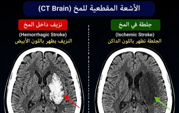 تعمل ايه لو شكيت في جلطه في المخ "Stroke"