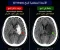 تعمل ايه لو شكيت في جلطه في المخ "Stroke"