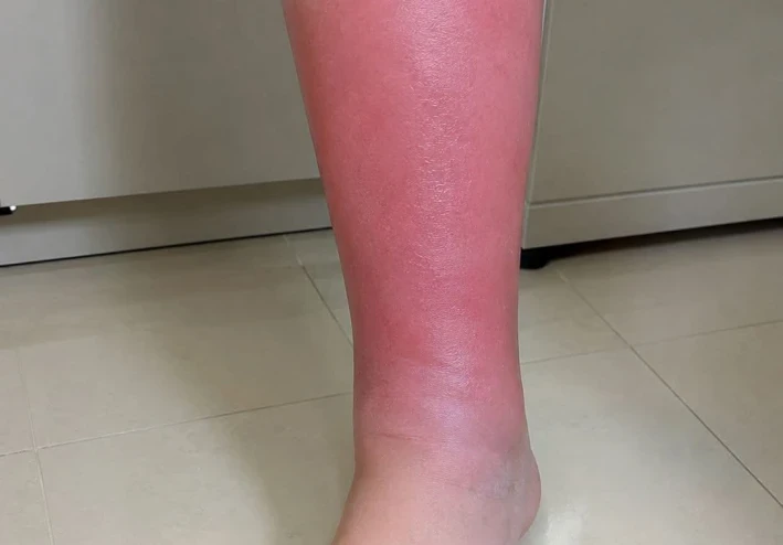 الالتهاب الخلوي تعريفه واعراضه والتشخيص والعلاج Cellulitis