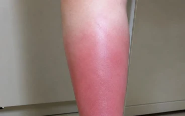 الالتهاب الخلوي تعريفه واعراضه والتشخيص والعلاج Cellulitis 