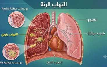 التهاب الرئة مش مجرد شويه  برد عادية.. إزاي تعدي منه على خير؟"