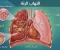 article image for التهاب الرئة مش مجرد شويه  برد عادية.. إزاي تعدي منه على خير؟"
