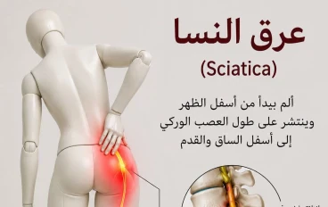 هنتكلم عن عرق النسا (Sciatica