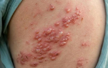 إيه هو الحزام الناري؟  (Herpes Zoster