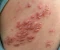 صورة مقال إيه هو الحزام الناري؟  (Herpes Zoster