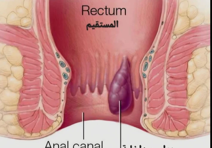 للنزيف من فتحة الشرج وهو ⬅️ البواسير.. (Hemorrhoid
