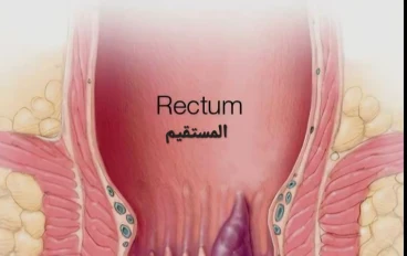 للنزيف من فتحة الشرج وهو ⬅️ البواسير.. (Hemorrhoid