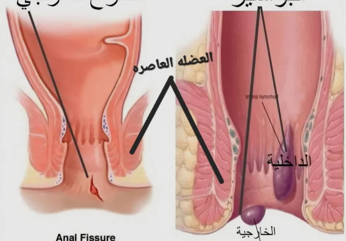 هنتكلم عن البواسير الخارجية، والشرخ الشرجي