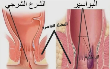هنتكلم عن البواسير الخارجية، والشرخ الشرجي