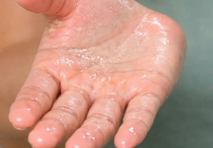 فرط التعرق (Hyperhidrosis 💧