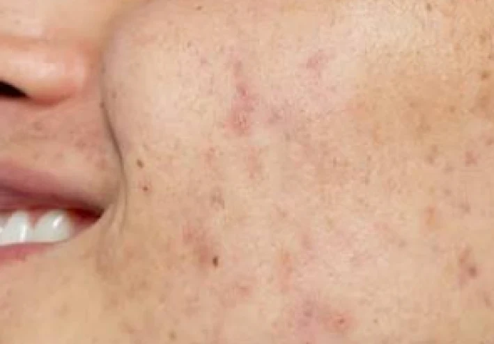 ازاى تعرف نوع الحبوب فى وشك؟ (الفرق بين حب الشباب والحب الفطري والوردية)