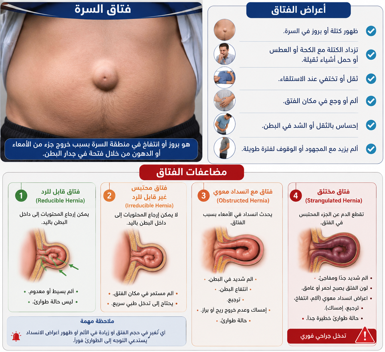 اعراض الفتاق ومضاعفاته وتشخيصه وعلاجه 