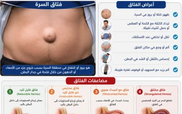 اعراض الفتاق ومضاعفاته وتشخيصه وعلاجه 