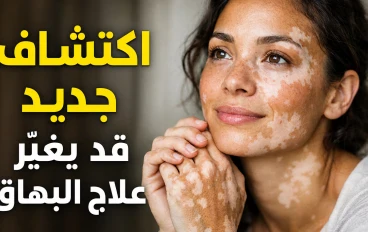 اكتشاف علمي جديد يمنح الأمل لمرضى البهاق.. هل يقترب العلاج؟