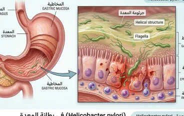جرثومة المعدة: الأعراض والأسباب وطرق التشخيص والعلاج والوقاية