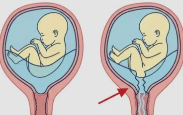 تمزق الأغشية المبكر أثناء الحمل الأسباب، الأعراض، التشخيص، المضاعفات،و العلاج (Premature rupture of membrane) 