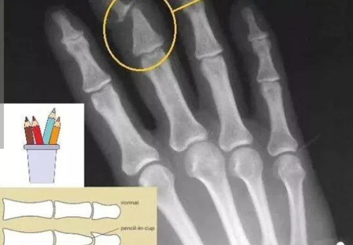 التهاب المفاصل المصاحب للصدفية   psoriatic arthiritis