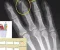 صورة مقال التهاب المفاصل المصاحب للصدفية   psoriatic arthiritis