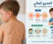 صورة مقال الجدري المائي الأسباب، الأعراض، المضاعفات، طرق الوقاية والعلاج