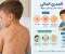 صورة مقال الجدري المائي الأسباب، الأعراض، المضاعفات، طرق الوقاية والعلاج