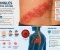 صورة مقال Shingles: Symptoms, Causes, Treatment, and Prevention