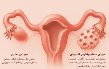 متلازمة تكيس المبايض (PCOS): الأعراض والأسباب والعلاج +نصائح للوقاية 