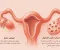 صورة مقال متلازمة تكيس المبايض (PCOS): الأعراض والأسباب والعلاج +نصائح للوقاية 