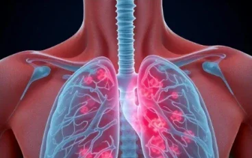 الالتهاب الرئوي: كيف تبدأ العدوى داخل الرئة وما أحدث طرق علاجه؟
